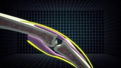 What causes knuckles to making popping sounds? Instructional Video