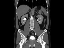 CAT Scan of Thorax and Abdomen Stock Footage