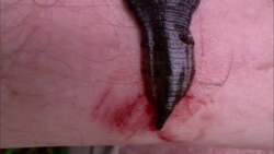 A leech sucks blood from a human arm. Stock Footage