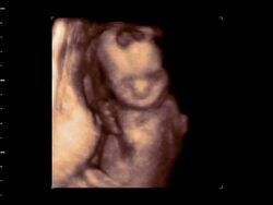 Foetus moving arms, 4D ultrasound.. Stock Footage
