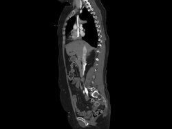 CAT Scan of Thorax and Abdomen Stock Footage