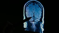 Brain Scan MRI 4k Stock Footage