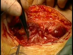 BCU Surgeon's hands stitching up internal layer of surgical wound Stock Footage