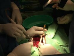 open-heart sergery, doctors around the operated child, in wolfson hospital. Save A Child''s Heart project. Stock Footage