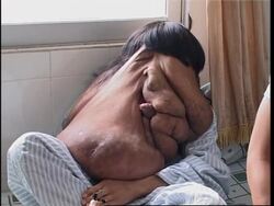 Man set for surgery to remove tumour from face GRAPHIC PIX News Clip