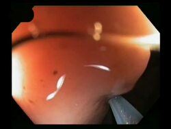 Colon cancer removal (polypectomy), endiscopic view.. Stock Footage