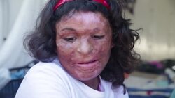 IV with Syrian family in Lesbos migrant camp Instructional Video