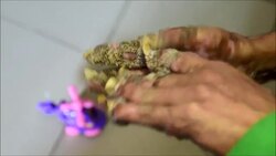 VOICED : El hombre arbol sufre una recaida y va por su 25 operacion News Clip