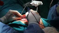 Close up view of open heart surgery Stock Footage