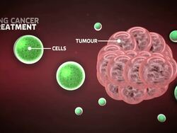 Pioneering stem cell treatment for lung cancer to be trialled in the UK News Clip