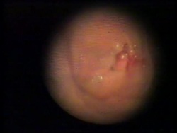 UK: NEW ANTI ALLERGY VACCINE DEVELOPED News Clip