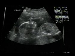 Baby Sucking Thumb Ultrasound Stock Footage