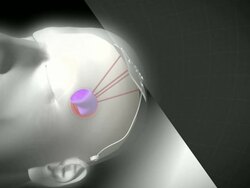 Hopes that brain implant can cure Parkinson's News Clip