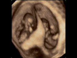 Twin foetuses at ten weeks old, 4D ultrasound scan.. Stock Footage