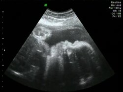 Baby Heartbeat Ultrasound Scan Stock Footage