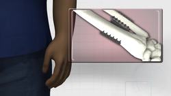 Baltimore boy Zion Harvey gets world's first pediatric double hand transplant Instructional Video