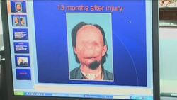 Man with no face qualifies for transplant ++WARNING: GRAPHIC IMAGES++ News Clip