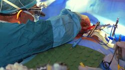 Two surgeons operating patient's heart Stock Footage