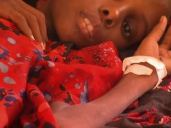 Somalian Children Suffering from Malnutrition News Clip