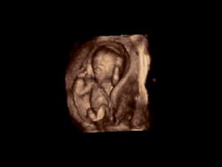 Foetus in the womb, rotating 3D ultrasound scan.. Stock Footage