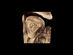 Triplet embryos in the womb, rotating 3D ultrasound scan.. Stock Footage