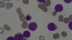 Myeloblast in Leukemia disease under microscope 1000X Stock Footage