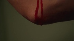 Blood flows from a bat bite on a man's elbow. Stock Footage