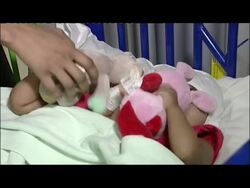 Post Operation Conjoined Twin Girls News Clip