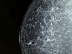 Mammogram X-Ray Stock Footage