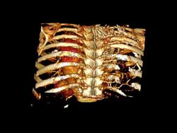 Aorta Scan Stock Footage