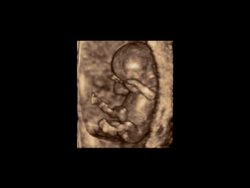 First trimester foetus in womb, rotating 3D ultrasound scan.. Stock Footage