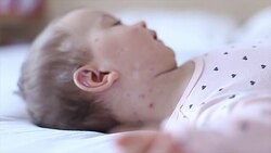 Crying baby girl with measles Stock Footage