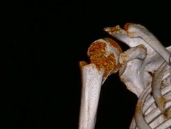 CU CT scan of broken shoulder / Vermont, USA Stock Footage