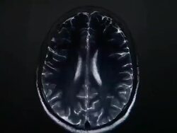 MRI brain scan Stock Footage