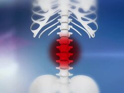 HD: Skeleton Indicates Injured Spine Stock Footage