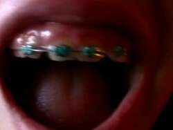 kid mouth with braces Stock Footage