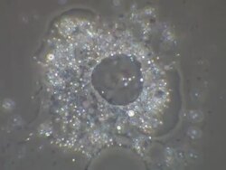 Amoeba exploding under pressure of cover slip Stock Footage