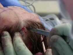 Facelift operation, clip 6 of 24. The surgeon makes an incision in the patient's scalp, before using a cauteriser to seal the wound edges and prevent blood loss Stock Footage