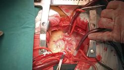 Coronary fistula Stock Footage