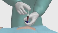 Study finds donor stem cells can repair heart damage Instructional Video