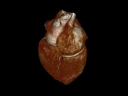 Cardiac CT Angiography Stock Footage