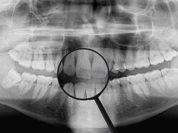 teeth roentgenogram Stock Footage