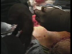 USA: 50 HOSPITALS SET UP CARE UNITS TO AVOID BLOOD TRANSFUSIONS News Clip