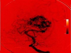 Angioplasty Stock Footage