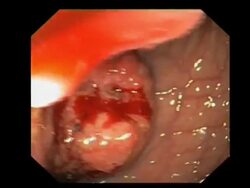 Rectal cancer. Endoscopic view of a malignant (cancerous) tumour in a patients rectum.. Stock Footage