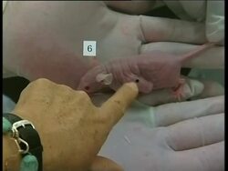 Early research shows malignant breast cancer cells might be safely killed off News Clip