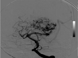 Brain Angio Stock Footage