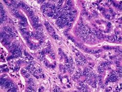 Microscopic image of human colon cancer cells Stock Footage