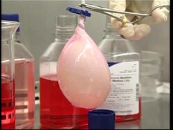 First human recipient of laboratory-grown bladder News Clip