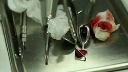 dental implant. Stock Footage